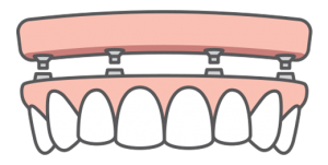 A top arch of teeth being replaced with dental implants