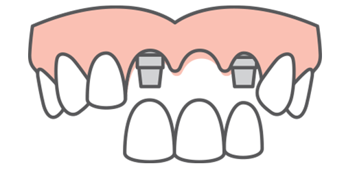 A top arch of teeth receiving multiple dental implants