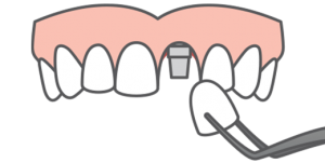 Graphic of a top arch of teeth receiving a dental implant